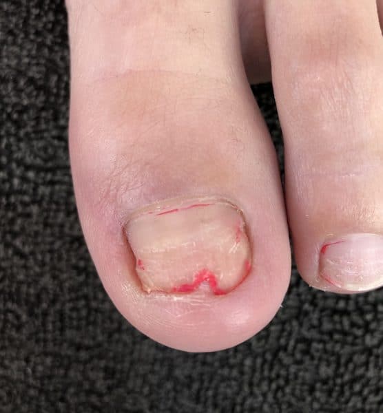Damaged toenail before nail service