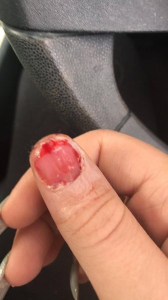 Trauma - caught in door.