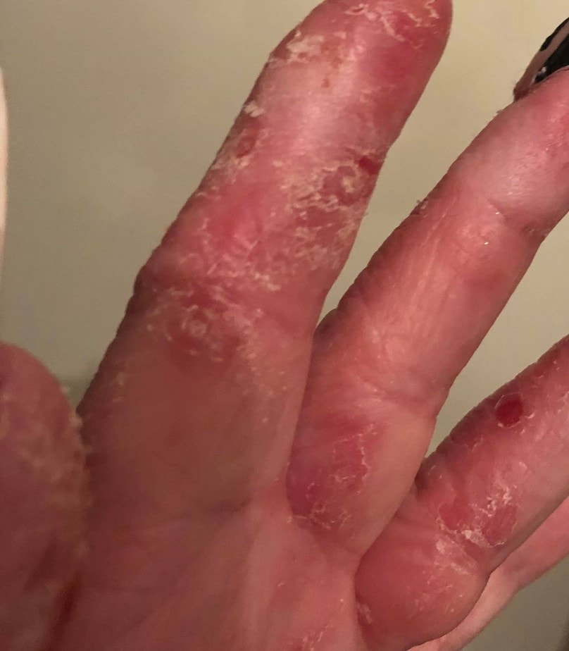 Katie Barnes allergy