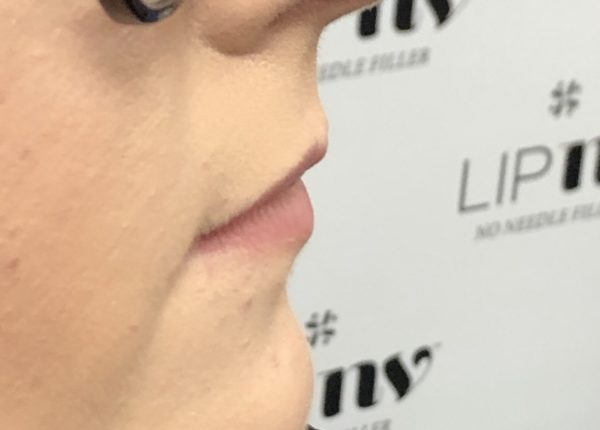 Kat: Before Lip NV No Needle Filler treatment