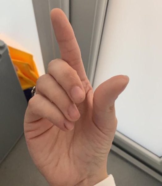 One year post-flare up after changing working techniques