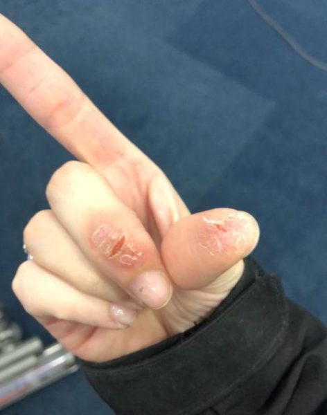 During an allergic flare up