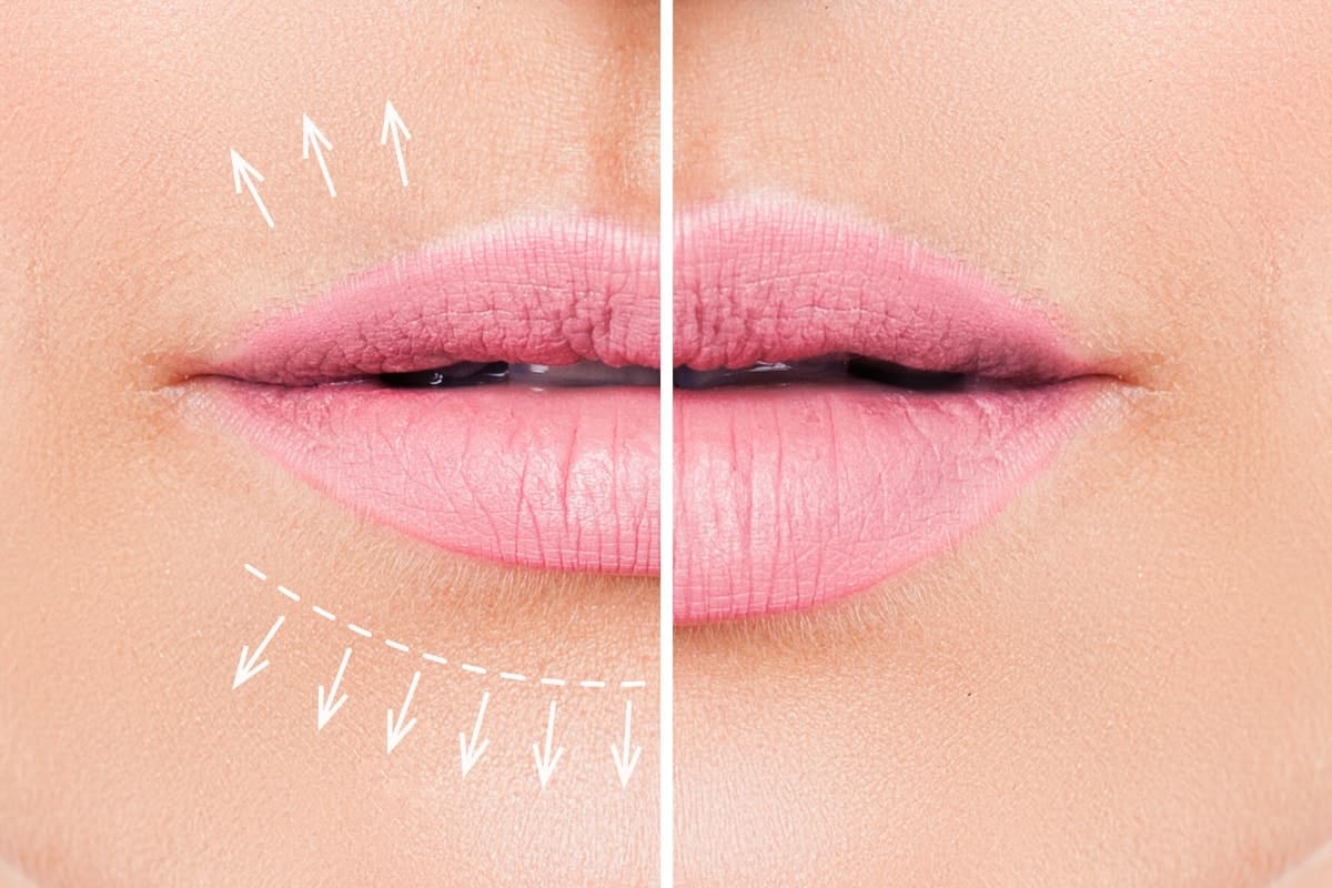 lip filler