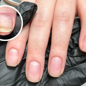 Natural Nail And Onycholysis Lucy Price Marshall