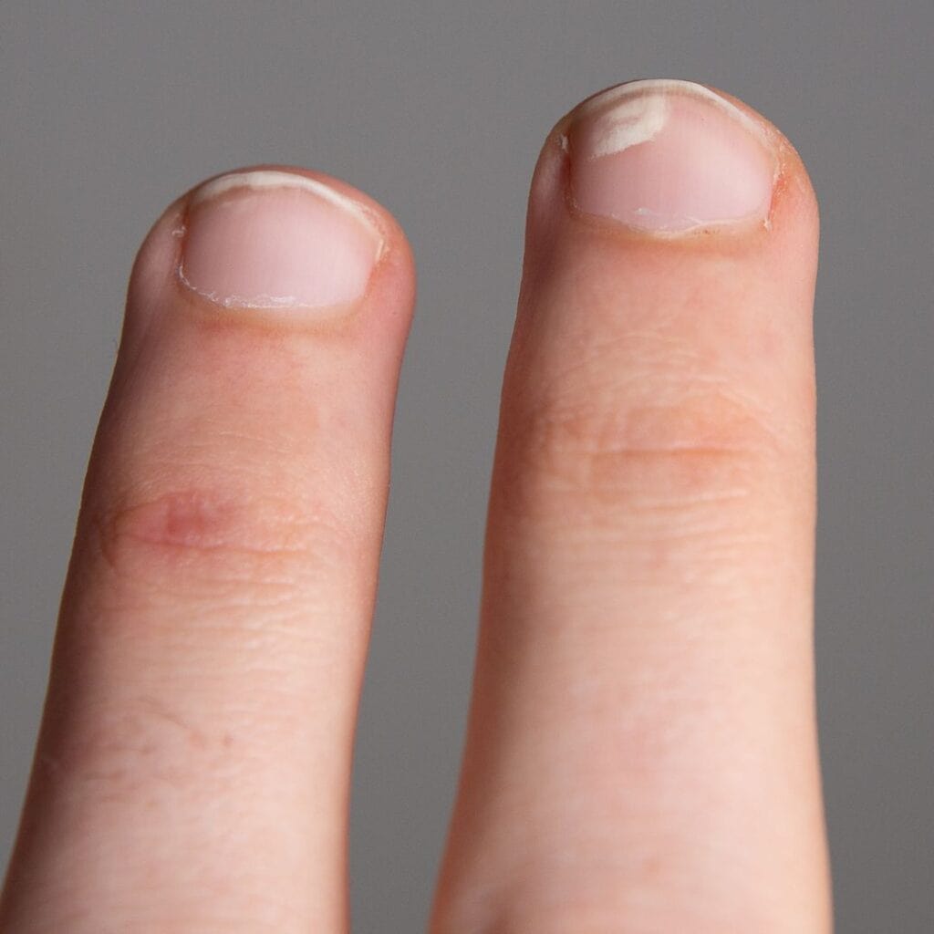 Damage to the nail matrix can cause white spots on the nail plate