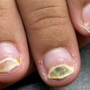 Instagram.com:nailsavvyy greenies nails is it mould